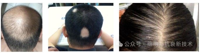 干細胞外泌體在生發領域的應用