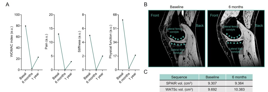 對(duì)股骨軟骨進(jìn)行人工分割獲得的定量容積分析